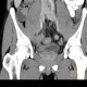 Crohn's disease of neoterminal ileum, abscess: CT - Computed tomography
