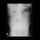 Crohn's disease, rupture of ileum, peritonitis: X-ray - Plain radiograph