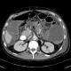 Crohn's disease, rupture of ileum, peritonitis: CT - Computed tomography