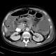 Crohn's disease, rupture of ileum, peritonitis: CT - Computed tomography