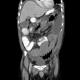 Crohn's disease, rupture of ileum, peritonitis: CT - Computed tomography