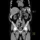 CT peritoneography: CT - Computed tomography