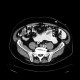 CT peritoneography: CT - Computed tomography