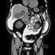 CT peritoneography: CT - Computed tomography