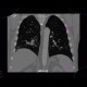 CT angiogram sign, acute lung embolism, lung infarction: CT - Computed tomography