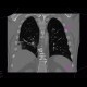 CT angiogram sign, acute lung embolism, lung infarction: CT - Computed tomography