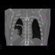 CT angiogram sign, acute lung embolism, lung infarction: CT - Computed tomography