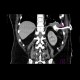 CT fistulography, enterocutaneous fistula: CT - Computed tomography