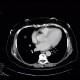 Lung carcinoma, accidental finding on enterography: CT - Computed tomography