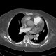 CTEPH, chronic thromboembolic pulmonary arterial hypertension: CT - Computed tomography