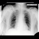 Central venous line, persistent left superior vena cava: X-ray - Plain radiograph