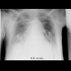 Malposition of central venous line: X-ray - Plain radiograph