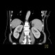 Fissural cyst of spleen: CT - Computed tomography