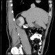 Cystic nephroma, Perlmann's tumour: CT - Computed tomography