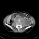Renal carcinoma, cystic, retroperitoneal lymphadenopathy: CT - Computed tomography