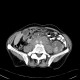 Renal carcinoma, cystic, retroperitoneal lymphadenopathy: CT - Computed tomography