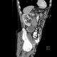 Renal carcinoma, cystic, retroperitoneal lymphadenopathy: CT - Computed tomography