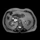 Serous cystadenoma of pancreas, cystadenoma, cystic tumour: MRI - Magnetic Resonance Imaging