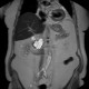 Serous cystadenoma of pancreas, cystadenoma, cystic tumour: MRI - Magnetic Resonance Imaging