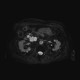 Serous cystadenoma of pancreas, cystadenoma, cystic tumour: MRI - Magnetic Resonance Imaging