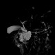 Serous cystadenoma of pancreas, cystadenoma, cystic tumour: MRI - Magnetic Resonance Imaging