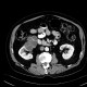 Cystadenoma of the kidney, Perlmann's tumour: CT - Computed tomography