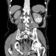 Pyelocystitis, narrowing of calyceal neck: CT - Computed tomography