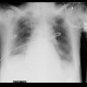 Malposition of central venous line: X-ray - Plain radiograph