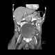 Carcinoma of urinary bladder, invasion into prostate: CT - Computed tomography