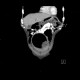 Carcinoma of urinary bladder, invasion into prostate: CT - Computed tomography