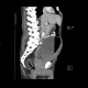 Carcinoma of urinary bladder, invasion into prostate: CT - Computed tomography