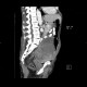 Carcinoma of urinary bladder, invasion into prostate: CT - Computed tomography