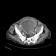 Carcinoma of urinary bladder, invasion into prostate: CT - Computed tomography