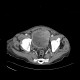 Carcinoma of urinary bladder, invasion into prostate: CT - Computed tomography