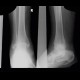 Calcar calcanei, calcifications in plantar aponeurosis, spur: X-ray - Plain radiograph