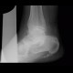 Calcar calcanei, calcifications in plantar aponeurosis, spur: X-ray - Plain radiograph