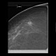 Breast carcinoma, small: MMG - Mammography