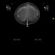 Breast carcinoma, small: MMG - Mammography