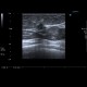 Breast carcinoma, small: US - Ultrasound