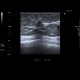 Breast carcinoma, small: US - Ultrasound