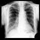 Initial chest radiograph: X-ray - Plain radiograph