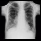 Carcinomatous lymphangoitis, lymphangoitis carcinosa, osteolysis of shoulder blade: X-ray - Plain radiograph