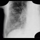 Carcinomatous lymphangoitis, lymphangoitis carcinosa, osteolysis of shoulder blade: X-ray - Plain radiograph