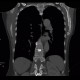 Carcinomatous lymphangoitis, lymphangoitis carcinosa, osteolysis of shoulder blade: CT - Computed tomography