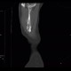 Carcinomatous lymphangoitis, lymphangoitis carcinosa, osteolysis of shoulder blade: CT - Computed tomography