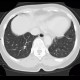 Carcinomatous lymphangoitis, lymphangoitis carcinosa, osteolysis of shoulder blade: CT - Computed tomography