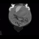 Carcinosis of the peritoneum: CT - Computed tomography