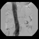 Caval filter: AG - Angiography