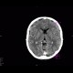 Cavum septi pellucidi: CT - Computed tomography