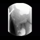 Scrotal hernia, cecum in scrotal hernia: RF - Fluoroscopy